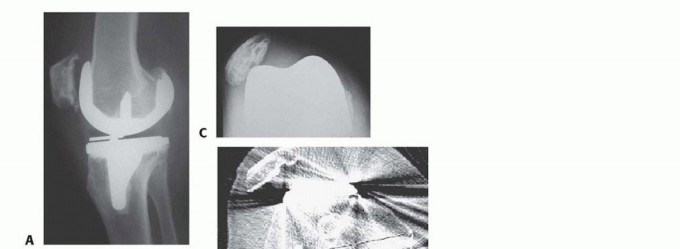 Illustration 4 for Correcting Stiffness in Revision TKA: Achieve Appropriate External Rotation