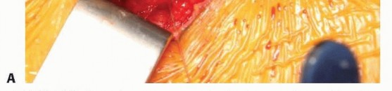 Illustration 41 for Anterior FAI Relief: Mini-Open Anterior Approach Explained