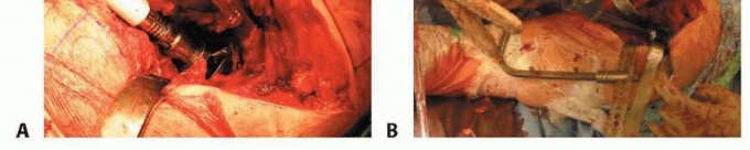 Illustration 10 for Hip Reimplantation Surgery: The Solution for Infected Implants
