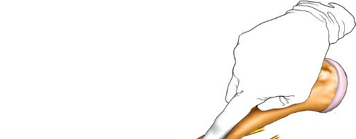 Illustration 29 for Mastering the Approach to the Distal Humerus: Safety & Skills