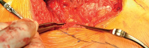 Illustration 64 for Direct Lateral Hip: Optimize Exposure with Sharp Curved Hohmann