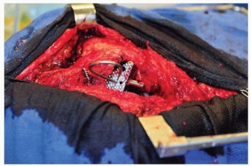 Illustration 47 for Cement in Cement Revision: Simplifying Complex Hip Revisions