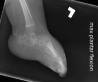 Illustration 2 for Rocker Bottom Foot: Accurate Diagnosis of Congenital Vertical Talus
