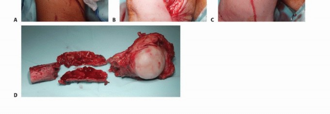 Illustration 13 for Restore Vital Function: Surgery for Type II Humeral Metastasis