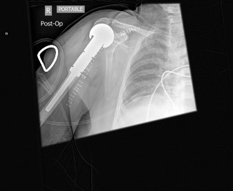 Illustration 8 for Mastering Orthopedics Oncology: Chondrosarcoma Cases