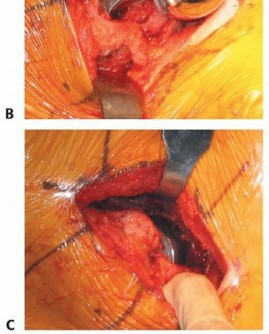 Illustration 41 for Hemiarthroplasty of the Hip: Indications & Types Explained
