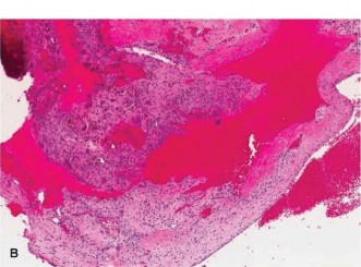 Illustration 3 for Challenging Oncology Cases: Aneurysmal Bone Cyst Diagnosis