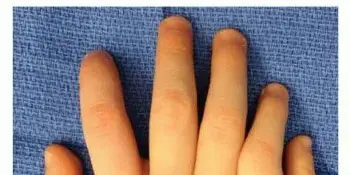 صورة توضيحية لـ الزائدة الإصبعية (كثرة الأصابع): دليل شامل للمرضى مع الأستاذ الدكتور محمد هطيف