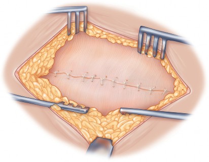 Illustration 69 for Direct Lateral Hip: Optimize Exposure with Sharp Curved Hohmann