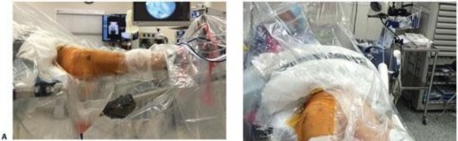 Illustration 91 for Periarticular Arthroscopy: Addressing Medius & Minimus Tears