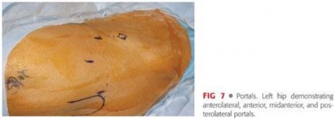 Illustration 67 for Precision Hip Arthroscopy: Unlock Access to the Peripheral Compartment