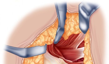 Illustration 6 for Unlock the Figure Posterior Approach to the Hip