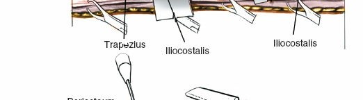 Illustration 405 for Approach to the Lumbar Spine: Mastering Techniques & Anatomy