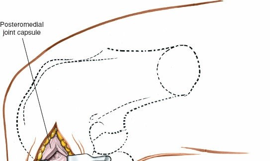 Illustration 61 for Mastering Knee Approaches: Spotlight on Superficial Medial Ligament