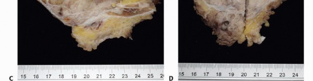 Illustration 62 for Sacral Tumor Surgery: Safeguarding Bowel & Bladder Control