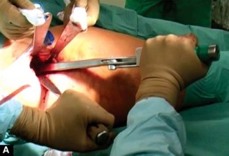 Illustration 13 for Mastering the Anterolateral Approach in Minimally Invasive Hip Replacement