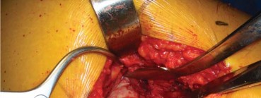 Illustration 93 for Successful Total Hip Replacement in Developmental Dysplasia