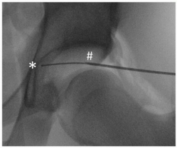 Illustration 13 for Beyond Knee Surg: Hip Arthroscopy for Sports Injuries