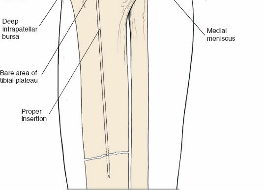 Illustration 128 for Surgical Access: Mastering the Tibia's Surface & Fibula Approaches