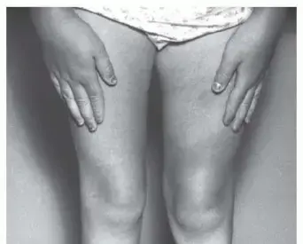 صورة توضيحية لـ علاج عدم التحام عظم الساق الخلقي (الكسر الكاذب) عند الأطفال: دليل شامل وأمل جديد مع الدكتور محمد هطيف