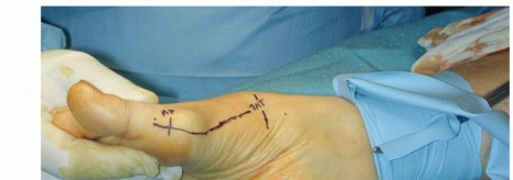 Proximal Chevron Osteotomy: Enhanced Stability with Plate Fixation