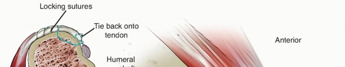 Illustration 32 for Restore Shoulder Function with Latissimus Dorsi Tendon Transfer