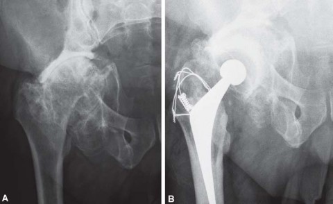 Illustration 38 for Expert Bone Grafting for Primary Total Hip Replacement Success