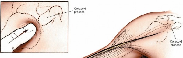 Illustration 3 for Mastering the Approach to the Distal Humerus: Safety & Skills