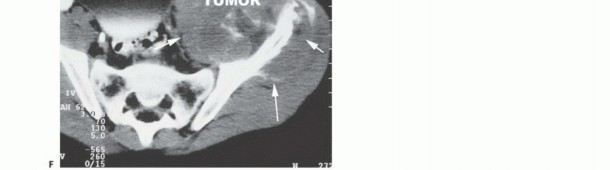 Illustration 37 for Understanding Benign Bone Tumors: Your Complete Preoperative Guide