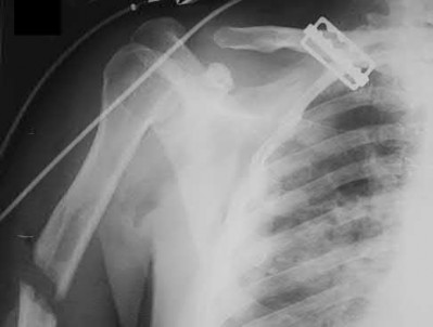 Illustration 133 for OrthoCash: Trauma MCQs & Cases for a yearold woman