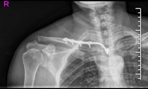 锁骨近端复杂骨折不再愁！DR CT X片精准解读，cc胸锁钩钢板低风险手术新突破，实现快速康复！