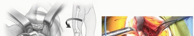 صورة طبية: النهج الأمامي لاستبدال مفصل الورك الكلي: ثورة في جراحة الورك مع الأستاذ الدكتور محمد هطيف في صنعاء