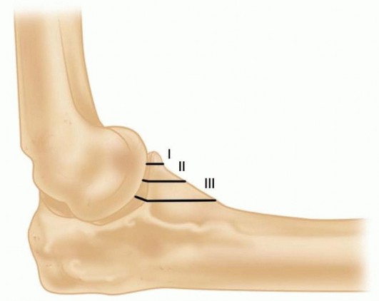 Illustration 3 for Restore Stability & Motion: Fixation of Fracture-Dislocations