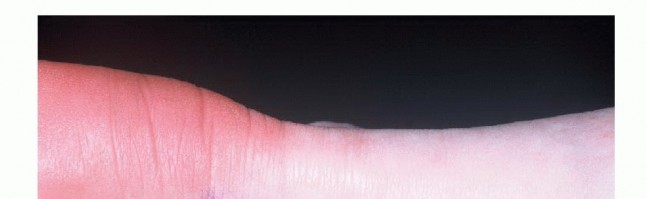 Open Management of Achilles: Your Guide to Lasting Relief