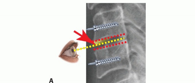 Illustration 8 for How ACDF Clears Your Posterior Disc Space for Lasting Relief