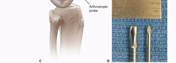 Illustration 40 for Dissecans of the Knee: What's the Difference – OCD vs. AVN?