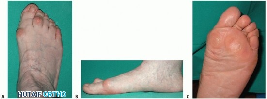 Minimally Invasive Hallux Valgus Correction: Is SERI Right For You?