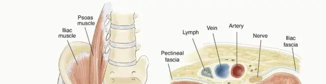 صورة توضيحية لـ شد عضلات الورك والفخذ (الإليوبسواس والمقربة): الأسباب، الأعراض، وخيارات العلاج الفعالة