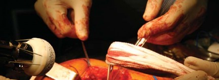 Illustration 29 for Metal on Metal Resurfacing: Enhanced Posterior Soft Tissue Repair