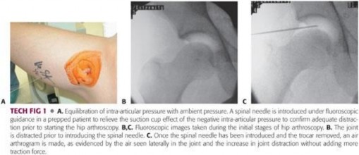 Illustration 174 for Understanding Hip Arthroscopy: The Basics Explained