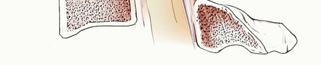 Illustration 25 for Stop Numbness & Instability: Corpectomy and Fusion Guide