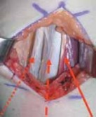 Illustration 14 for Unlocking Mobility: Distal Lengthening for Lateral Hamstring Muscle