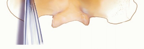 Illustration 5 for Achieve Stability: Posterior Cervical Lateral Mass Screw Fusion