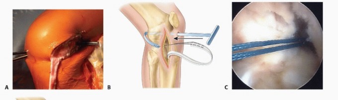 Illustration 11 for Optimizing ACL Reconstruction for Skeletally Immature Patients