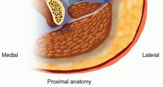 Illustration 4 for Retrograde Femoral Nailing: Optimizing Surgical Outcomes