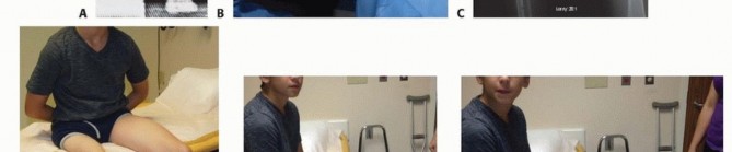 Illustration 14 for Treatment for Congenital Femoral Deficiency: What You Need to Know