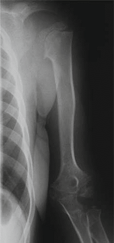 Illustration 6 for Understanding Multiple Epiphyseal Dysplasia: Orthopedic Cases