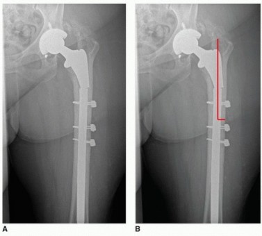 Illustration 3 for Extended Trochanteric Osteotomy: How et al Extended Revision THA Solutions