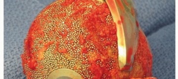 Illustration 9 for Uncemented Acetabular Revision: Optimizing Hemispherical Cup Use