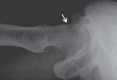Illustration 42 for Resolving Femoral Head Neck Impingement: Arthroscopic FAI Solutions